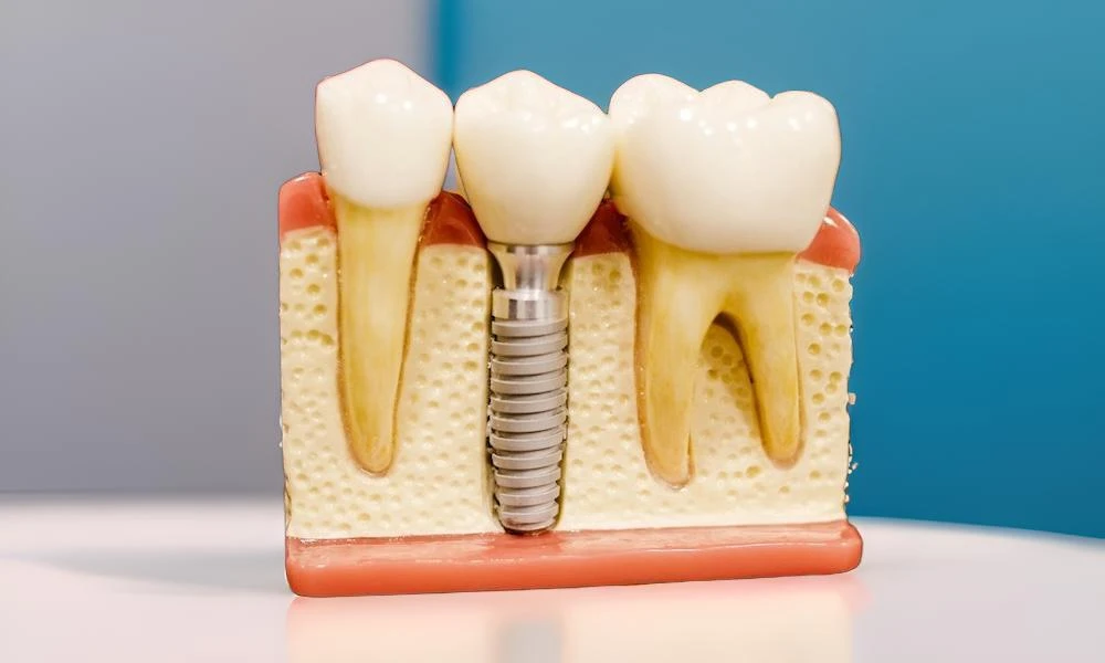 Photo of dental implant