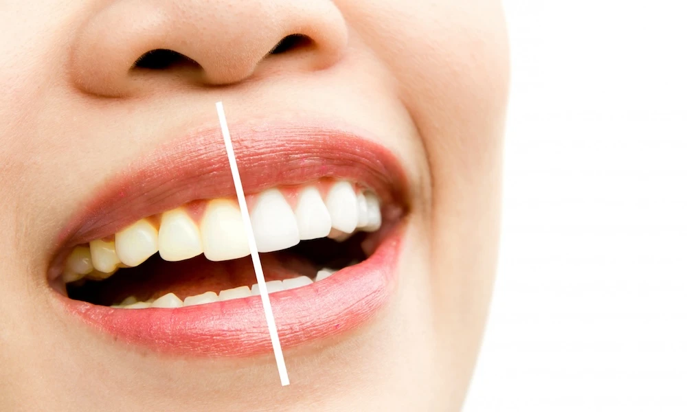 Photo of teeth whitening